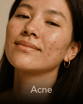 A lady looking in front and smiling with acne on her face.