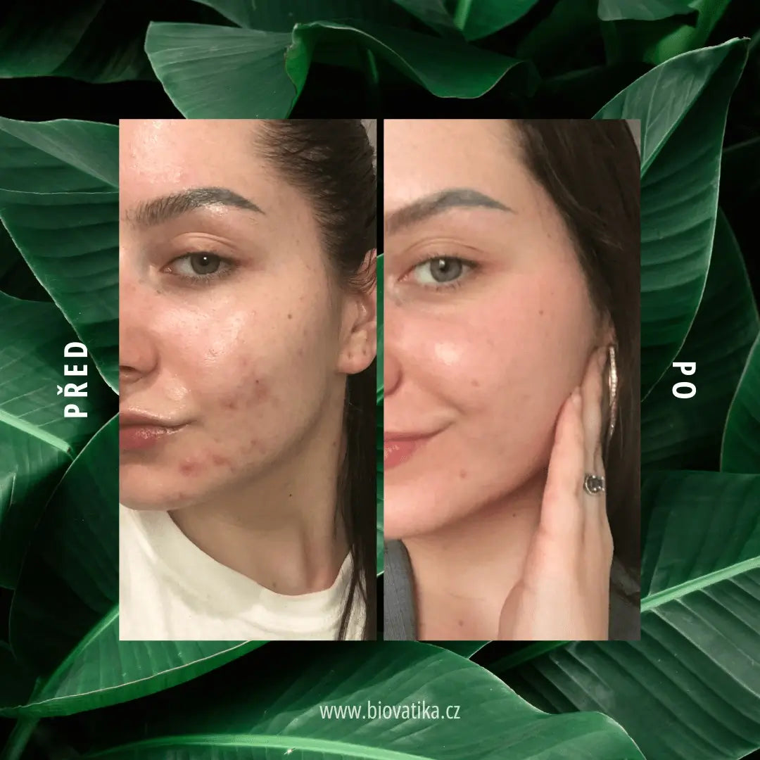 Anti-Acne Ritual – Comprehensive Care for Problematic and Oily Skin