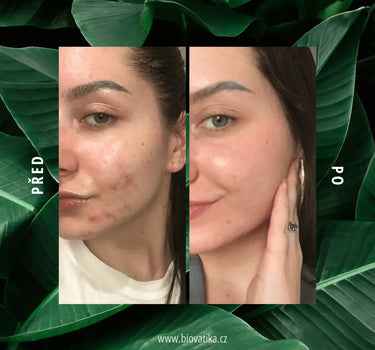 Anti-Akné Rituál – Komplexní péče pro problémovou a mastnou pleť